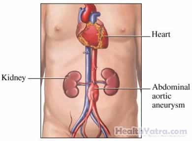 Abdominal Aortic Aneurysm Repair 1