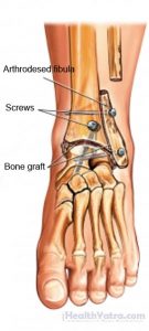 Arthrodesis of Foot and Ankle Open Surgery Cost in India, Treatment ...