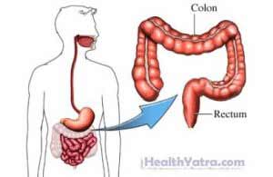 Colectomy Open SurgeryColon removal