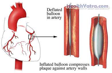 Coronary Angioplasty Balloon angioplasty