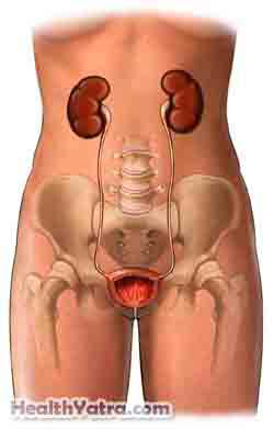 Radical Cystectomy 2