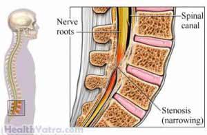 Achondroplasia Definition, Causes, Symptoms, Complications and Cost ...