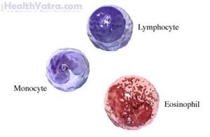 Acute Lymphoblastic Leukemia Definition, Causes, Symptoms & Treatment ...