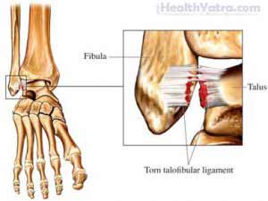 Ankle Sprain Definition Causes Symptoms Complications And Cost Surgery Treatment Hospital In