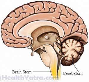 Arnold-Chiari Syndrome Definition, Causes, Symptoms, Complications and ...