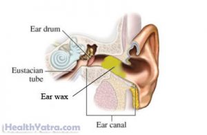 Cerumen Impaction