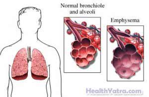 Chronic Obstructive Pulmonary Disease Definition, Causes, Symptoms ...