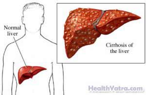 Cirrhosis Definition, Causes, Symptoms, Complications and Cost Surgery ...