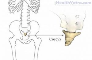 broken coccyx