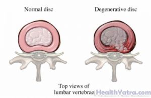 Degenerative Disk Disease Definition, Causes, Symptoms, Complications