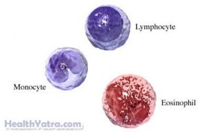 Hairy Cell Leukemia Definition, Causes, Symptoms, Complications and ...