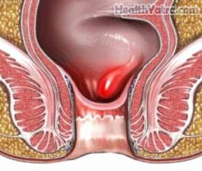 Hemorrhoidectomy