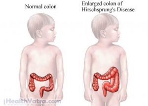 Hirschsprung Disease Definition, Causes, Symptoms, Complications and