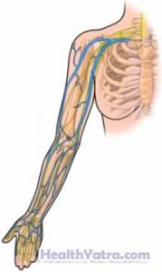 Peripherally Inserted Central Catheter