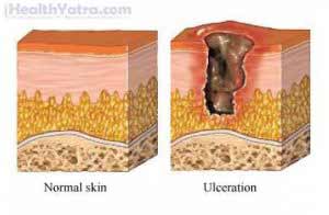 Pressure Sores Treatment in India, Causes, Symptoms and Top Hospital ...