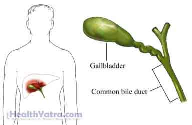 Primary Biliary Cirrhosis Definition, Causes, Symptoms, Complications ...