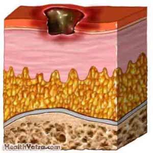 Pyoderma Gangrenosum Treatment in India, Causes, Symptoms and Top Hospital