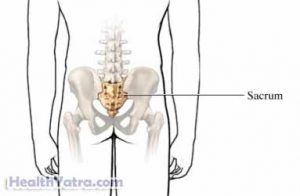 Tarlov Cyst Definition, Causes, Symptoms, Complications and Cost