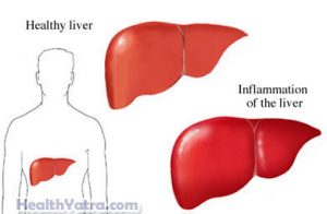 Toxic Hepatitis Definition, Causes, Symptoms and Treatment Cost in India