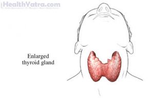 Nontoxic Nodular Goiter Definition, Causes, Symptoms, Complications and ...