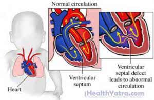 Tetralogy of Fallot Treatment in India, Causes, Symptoms and Top ...