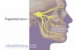 Trigeminal Neuralgia Definition, Causes, Symptoms and Treatment Cost in ...