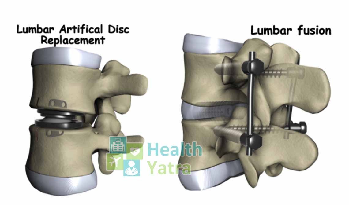 Why-Artificial-Disc-replacement-surgery-is-better-than-Spinal-Fusion ...