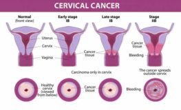 Cervical Cancer treatment in India, Cost Treatment Surgery Top Hospital ...