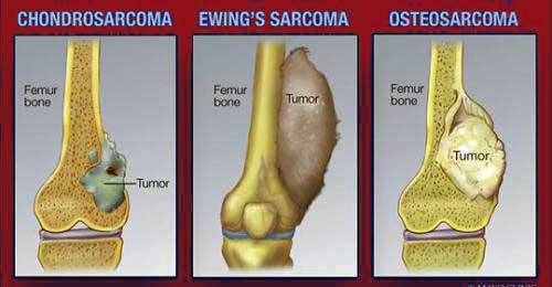 Types Of Bone Cancer Health Yatra