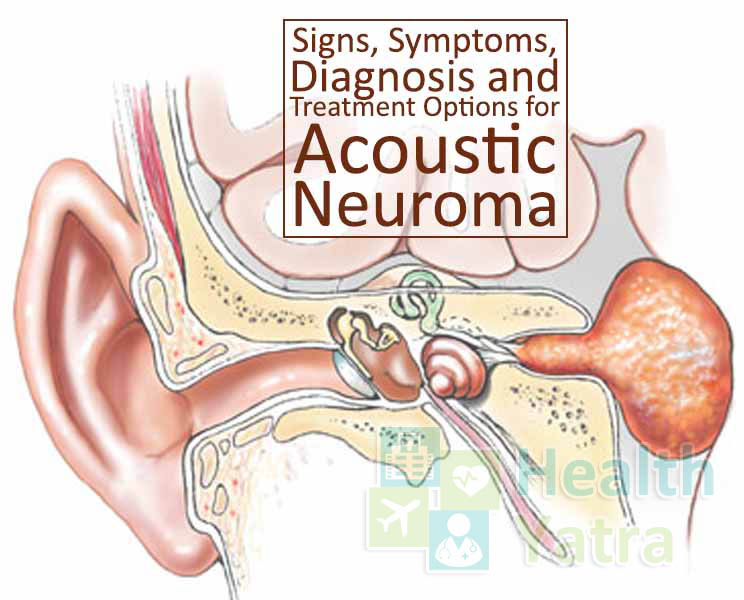 भारत में ध्वनिक न्यूरोमा उपचार