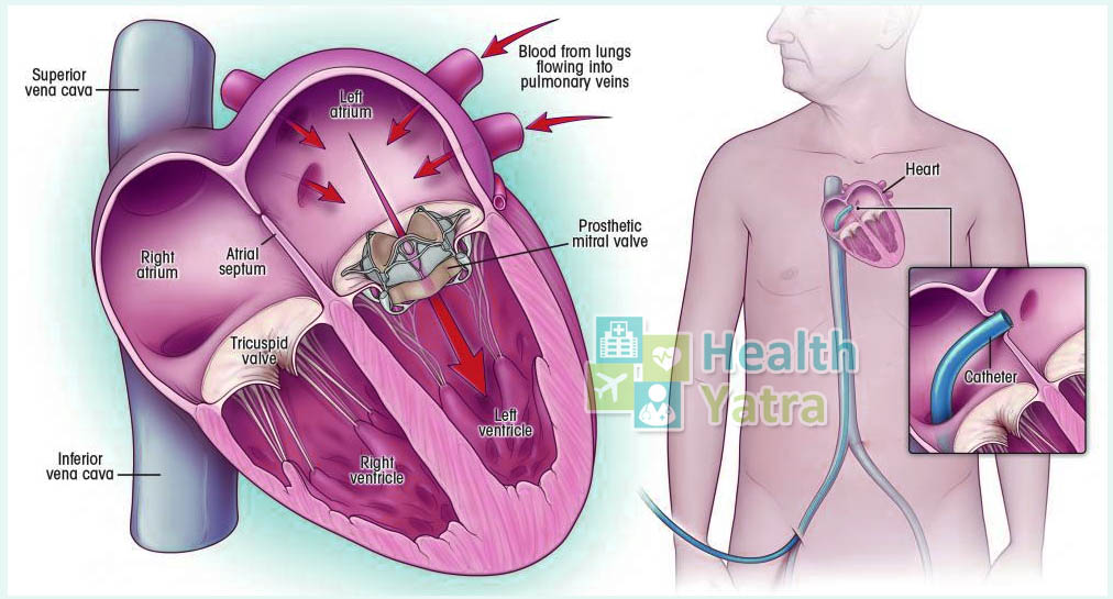 جراحة استبدال صمام القلب الأبهري في الهند مع HealthYatra