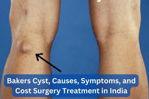 Bakers Cyst Causes Symptoms And Cost Surgery Treatment In India 